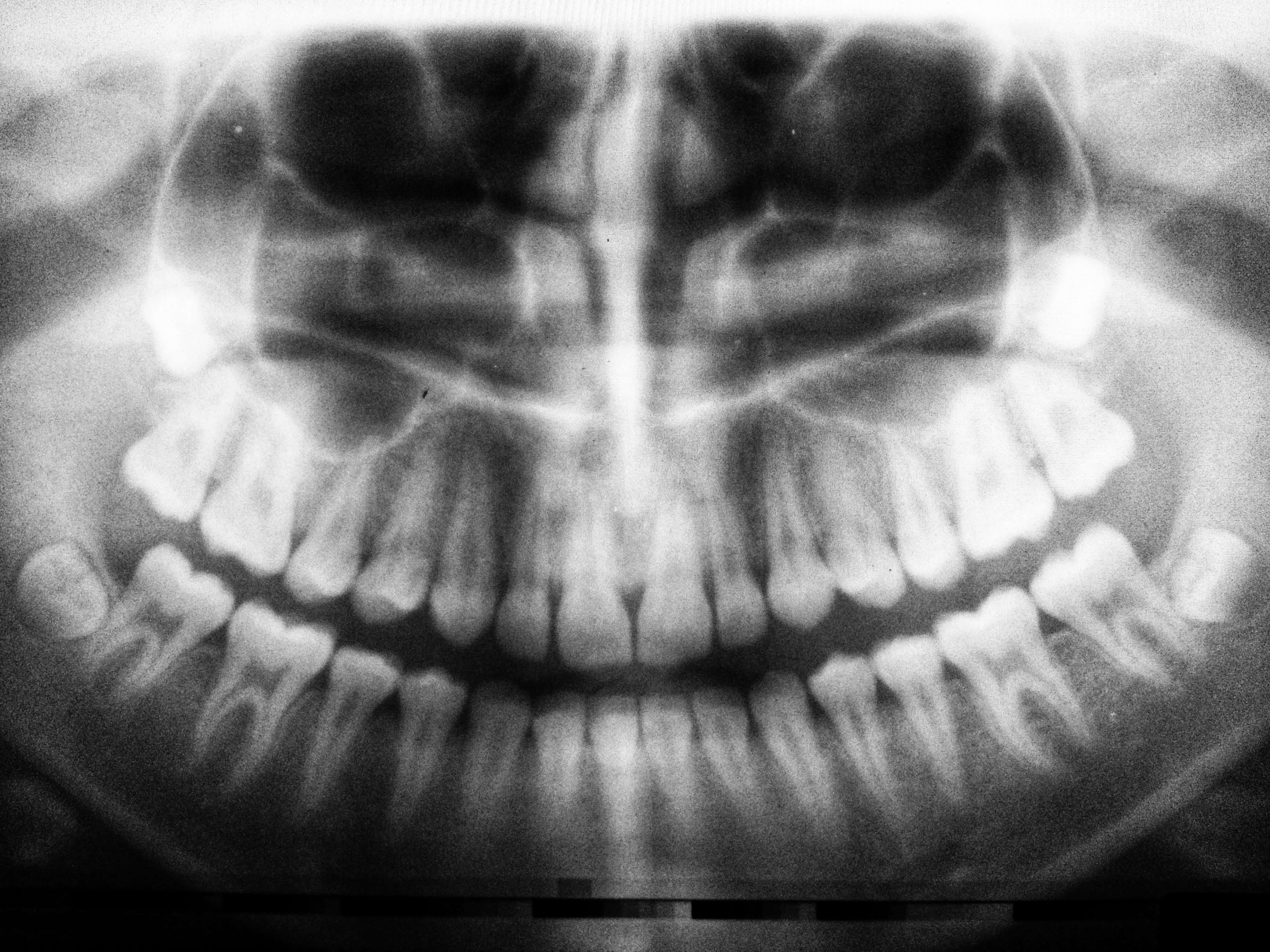 horizontal impacted wisdom teeth