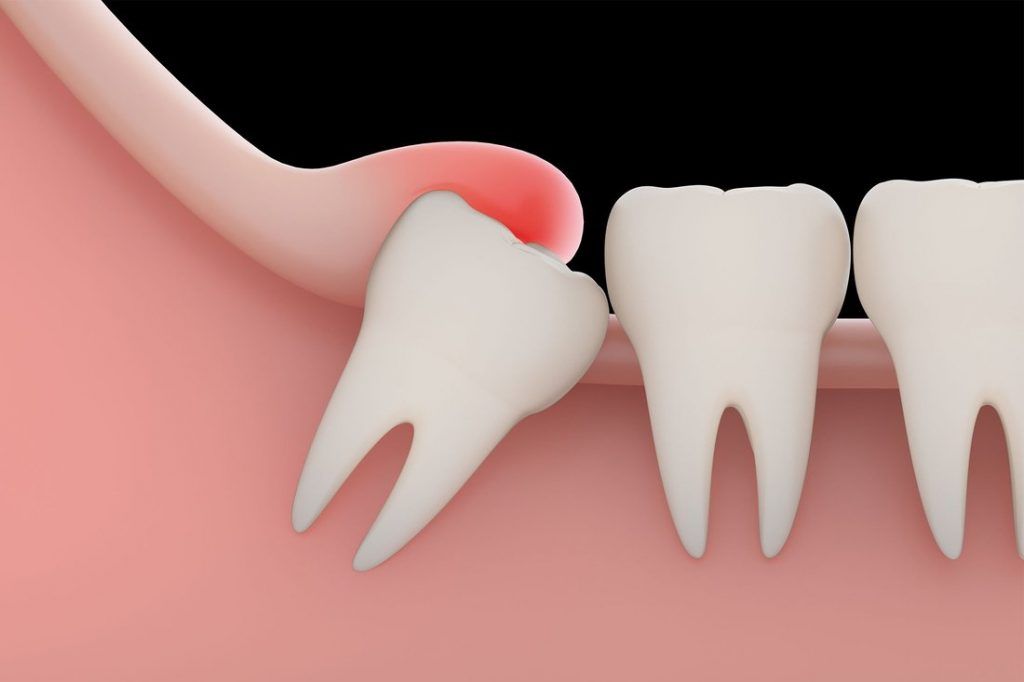 A Guide to Avoid Dry Socket after Wisdom Teeth Removal - Wisdom